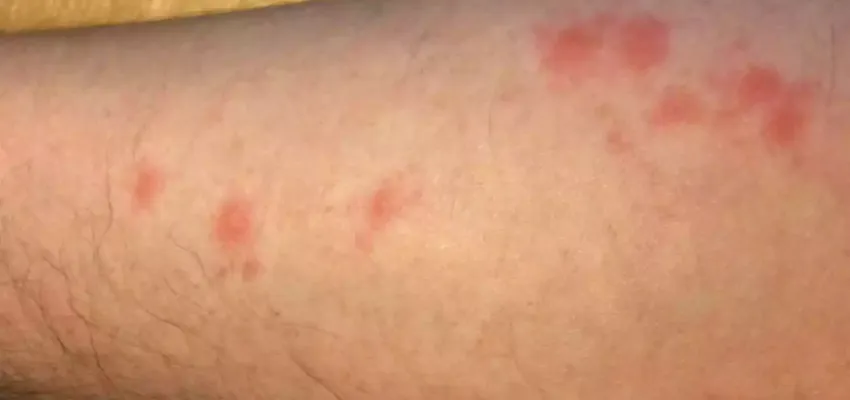 bed-bug-bite